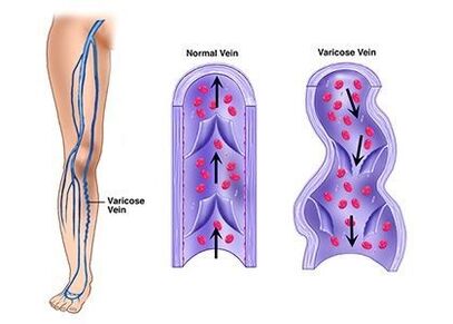 Neoveris prevents the development of vein pathologies