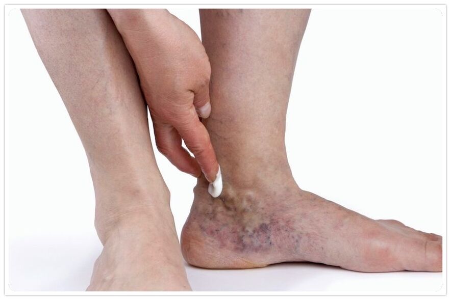 The benefits of the procedure to the veins