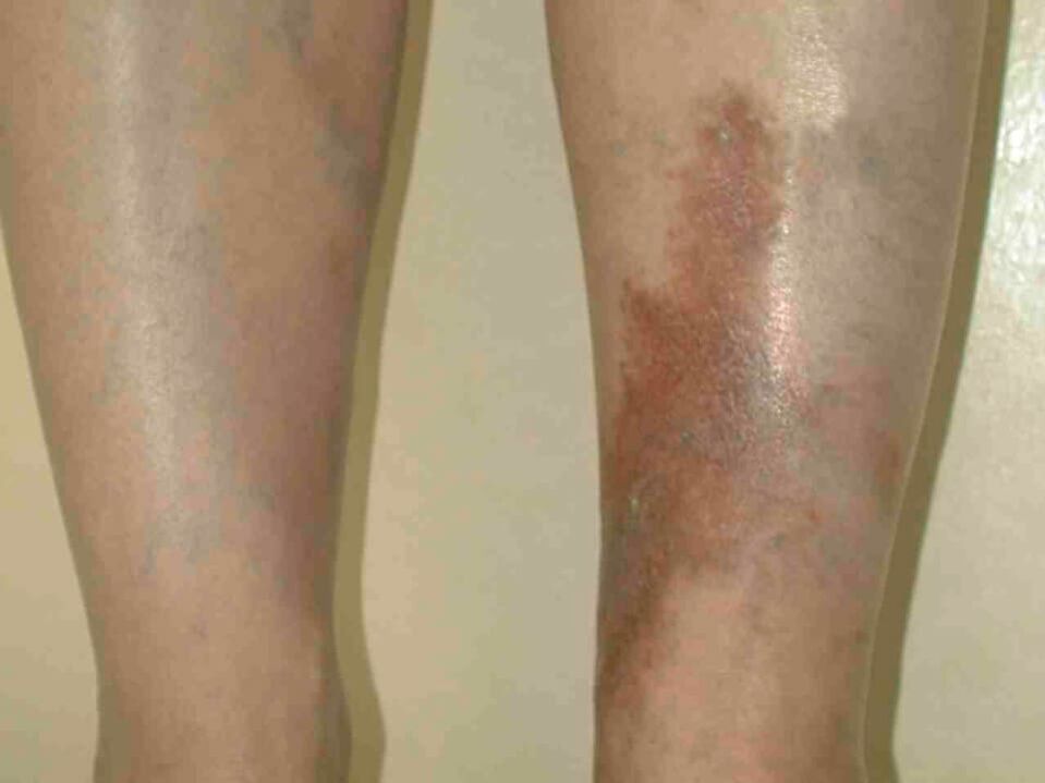 Stages of varicose veins
