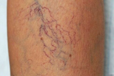 Why are varicose veins dangerous