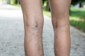 manifestations of varicose veins on the legs