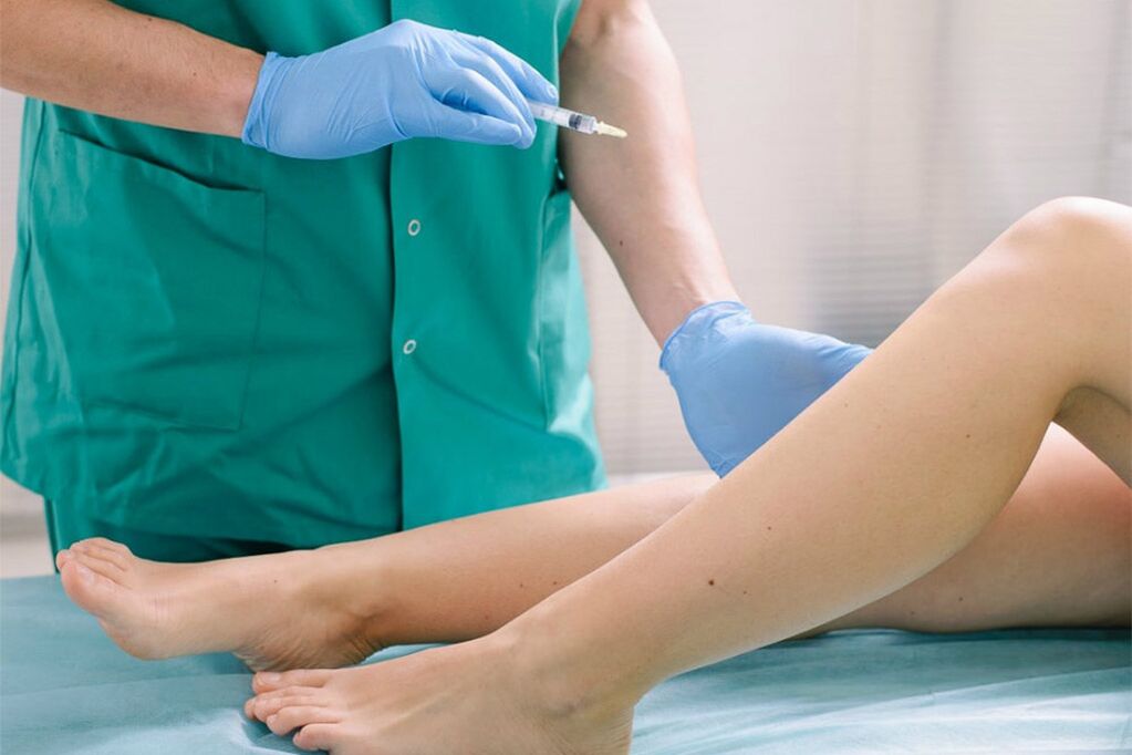 sclerotherapy for removal of varicose veins