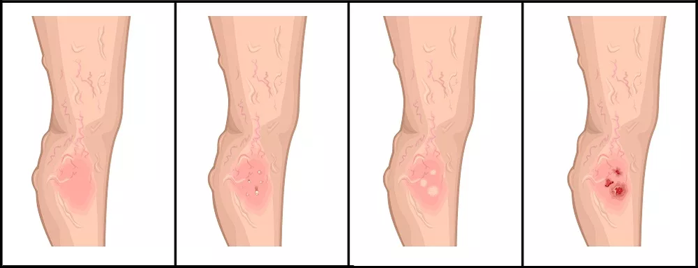 Stages of development of trophic ulcers in venous pathology