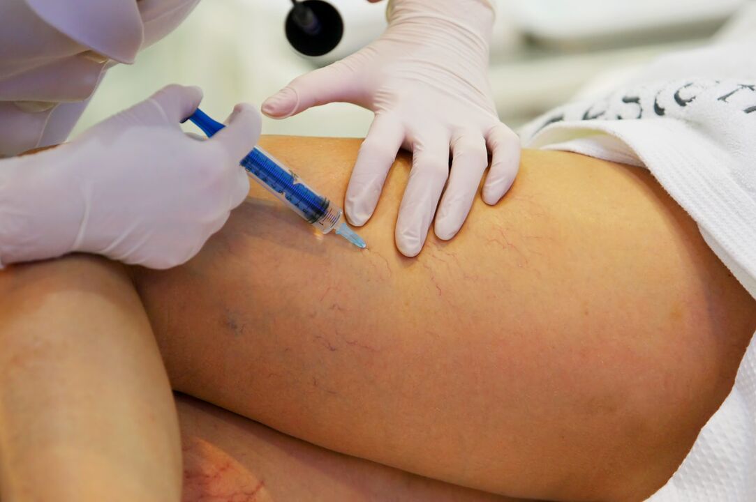 injection for the treatment of varicose veins