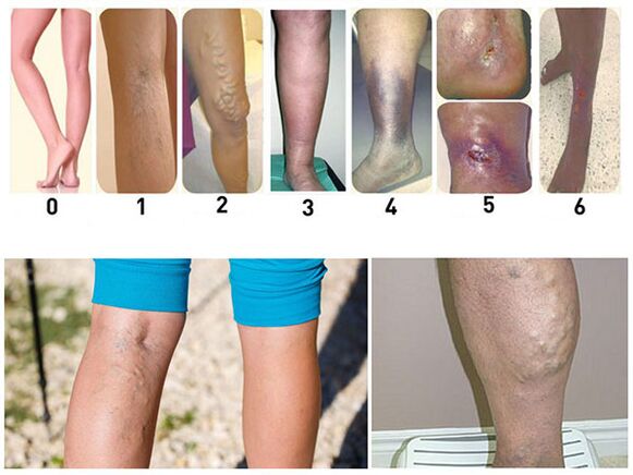 Stages of development of varicose veins of the lower extremities