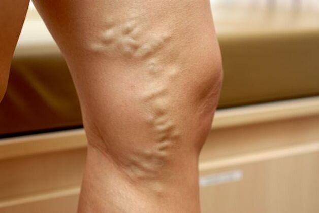 Protruding deformed vein on the leg with stage 3 varicose veins