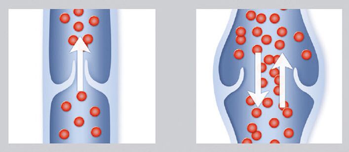 Healthy and damaged venous valve